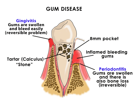 The disadvantages of deep cleaning teeth your teeth weekly