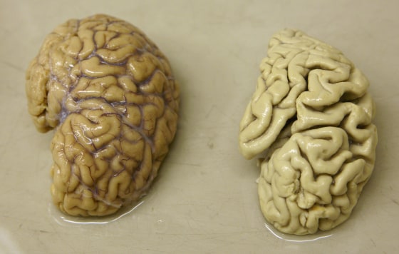 Image: Half a healthy brain is pictured next to half a brain of a person suffering from Alzheimer disease Belle Idee University Hospital in Chene-Bourg