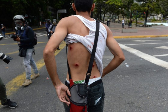 Image: A wounded protester shows his back as riot police clash with opposition demonstrators during a protest against the government of President Nicolas Maduro