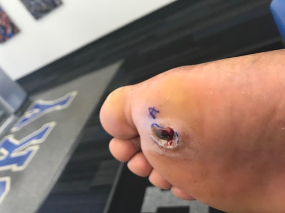 What Does Foot Melanoma Look Like Skin Cancer Can Hide As Spot On Sole