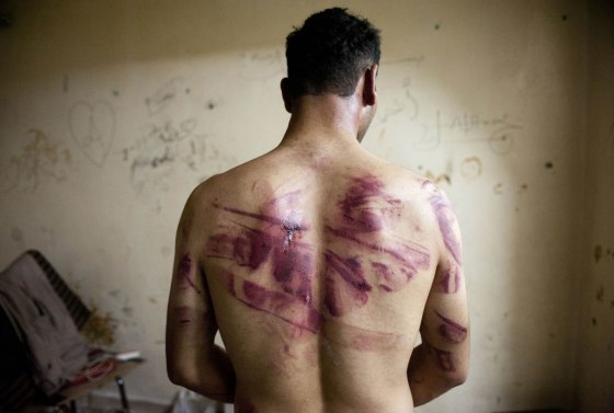 Image: A Syrian man shows marks of torture on his back, after he was released from regime forces, in the Bustan Pasha neighbourhood of Syria's northern city of Alepp