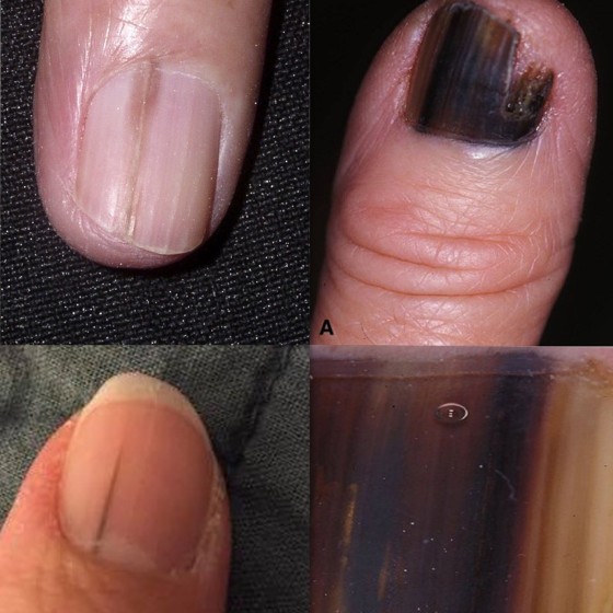 What does nail melanoma look like? Skin cancer can hide as line on nail