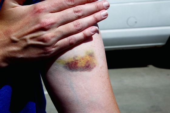 how-to-get-rid-of-bruises