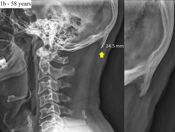 Tech Disorder Smartphones Linked To Bizarre Horn Like Skull Bumps