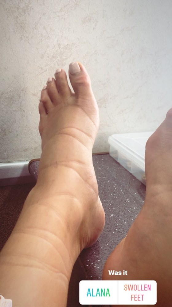 Pregnant Shay Mitchell Posts Photo Of Swollen Feet