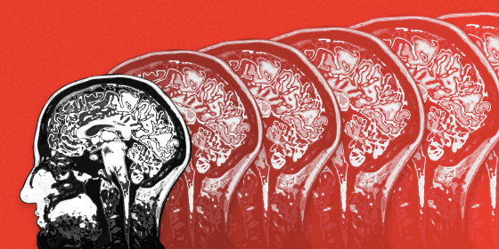 Image: Could inflammation be the key to finding a drug to treat Alzheimer's disease?