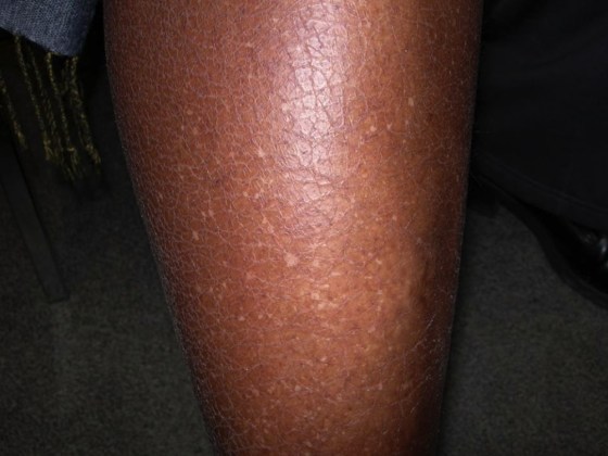 What causes sudden appearance of white round spots on legs? - Dr