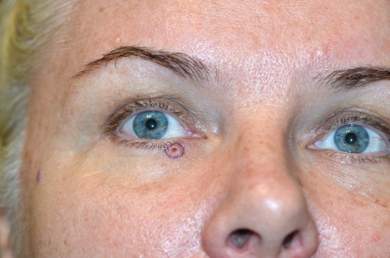 Smeared Mascara Beauty Mark Eyelid Bump Were Skin Cancer Smeared Mascara Beauty Mark Eyelid Bump Were Skin Cancer