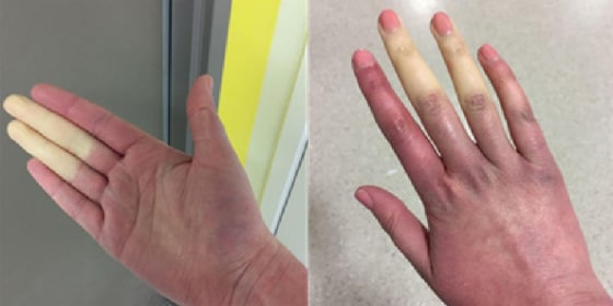 Raynaud's Disease Causes White Or Blue Fingers, Toes In Cold