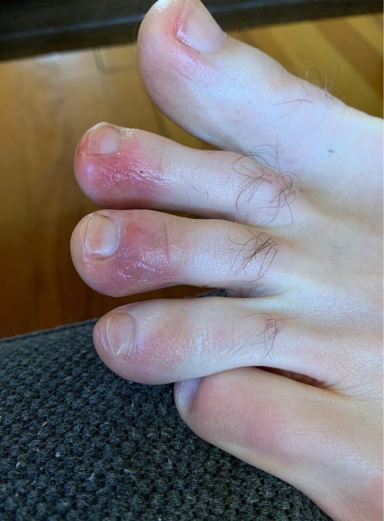 Covid Toes Dermatologists And Podiatrists Explain Covid 19 Toes