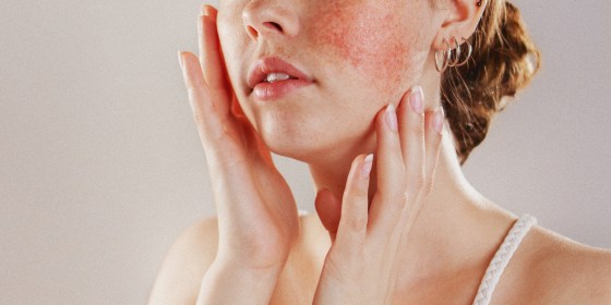 Rosacea: Treatments and causes for redness on face - TODAY