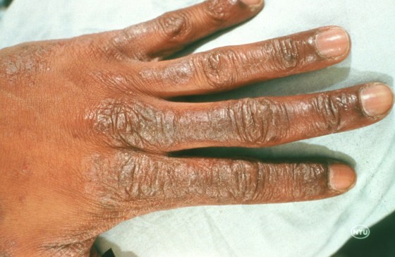 Skin Disorders: Pictures, symptoms, causes and help - TODAY