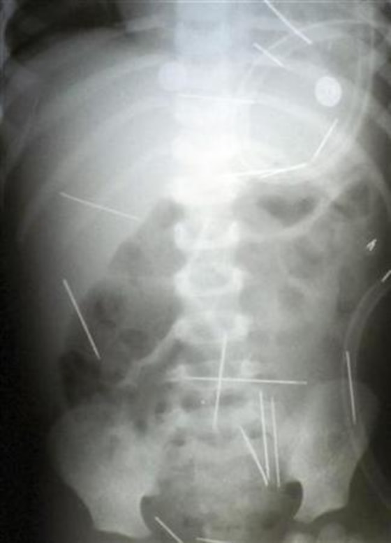 Undated X-ray shows dozens of needles in two-year-old boy in Salvador