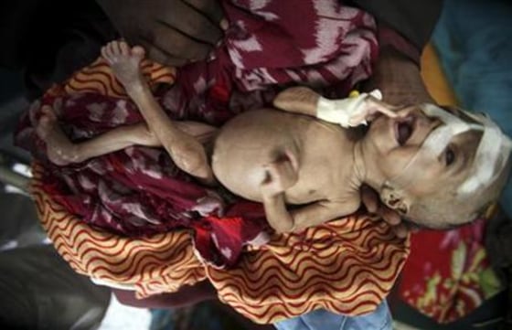 An internally displaced woman holds her malnourished son at the Banadir hospital in Somalia's capital Mogadishu