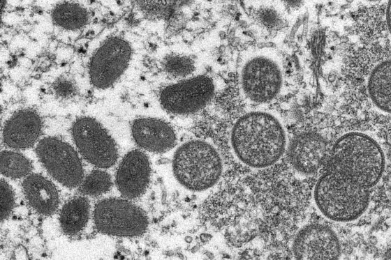An electron microscope image of monkeypox virions, left, and spherical immature virions, right, obtained from a sample of human skin. 
