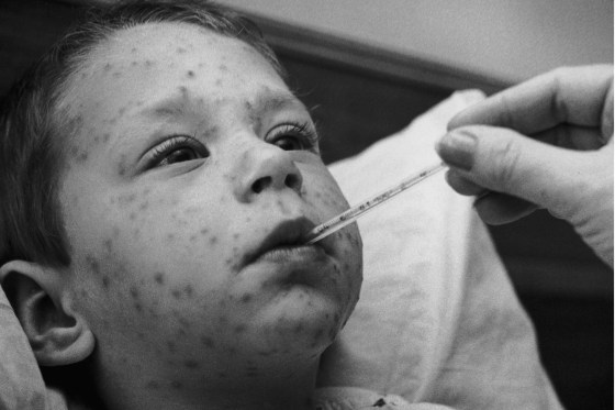 Chicken Pox Boy
