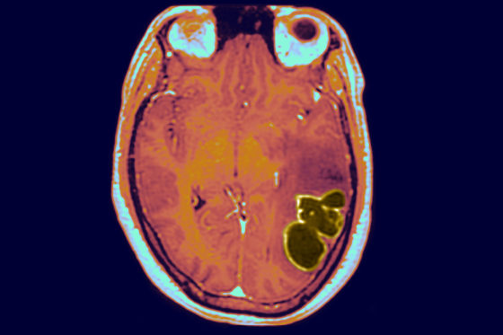 Unexplained rise in life-threatening brain infections in children ...