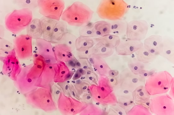 Paps smear under microscopy showing inflammatory smear with hpv related changes. Cervical cancer. SCC