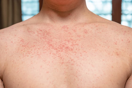 Measles on a young adult.