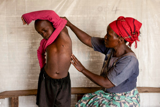 Fideline Kiza Kasao, left, checks her son for mpox