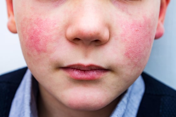 child with red rash cheeks