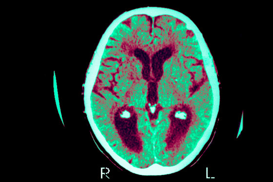 In Alzheimer’s, nerve cells in the brain at some point start to dysfunction, leading to debilitating memory loss.