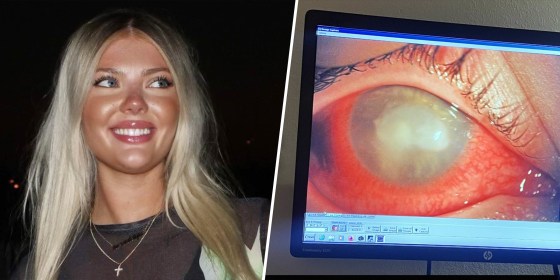 Woman 23 Fights Parasitic Eye Infection After Swimming In Contacts 0104