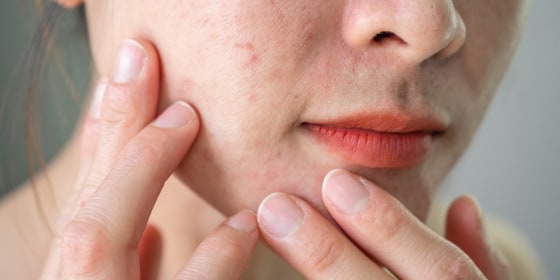 Pore vacuums exert light suction to remove dirt, debris, dead skin cells and other gunk from your pores.