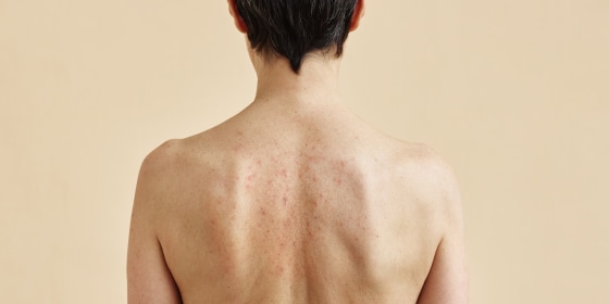 According to dermatologists, the first step in addressing acne is using a cleanser specifically formulated for body acne.