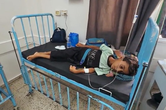 A boy suffering from malnutrition in the pediatric ward at Nasser Hospital in Khan Younis, Gaza, on July 30, 2025.