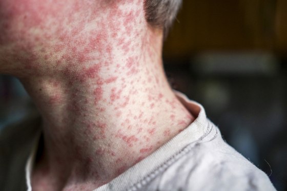 Skin covered with measles rash.