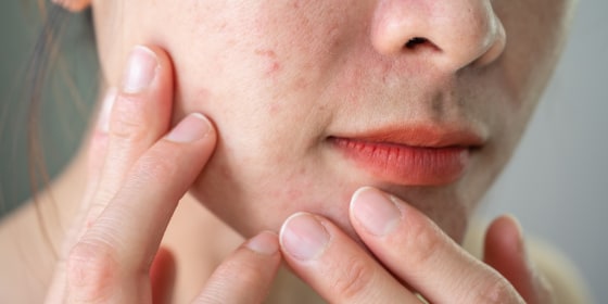 Your skin might temporarily break out when you start or stop a product, called “skin purging.”