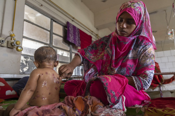 Measles Outbreak In Dhaka