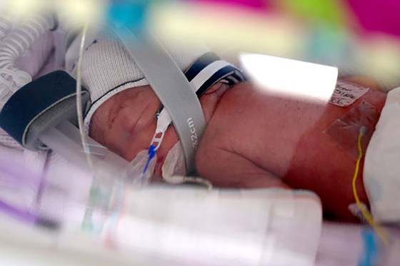 One of the identical baby girl quadruplets born at Royal Brisbane and Women’s Hospital.