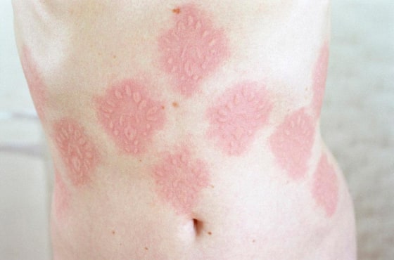 Due to an allergic condition, Ariana Page Russell's skin provides an unexpected canvas for