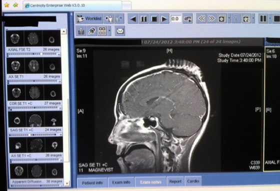 Caption: A MRI shows the track of the shotgun pellet through Petra Anderson's brain. The ammunition narrowly missed hitting the main blood vessels of the brain and sections that control key functions - like consciousness and being alive, her doctors said, calling her survival a