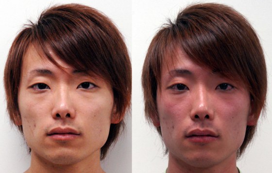 A condition called 'Asian flush' happens to certain people of Asian descent after they have consumed alcohol. The red blush, shown on right, is the result of a deficient gene.