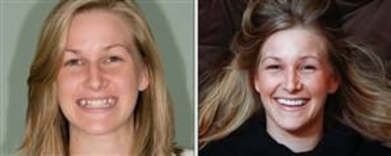 On the left, Emily Cheeseman smiles her baby-toothed smile. On the right, her baby teeth are gone, replaced with dental implants.
