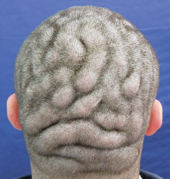 condition-makes-man-s-scalp-look-like-surface-of-brain