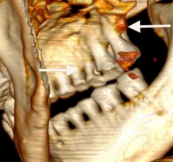Otzi the iceman, an astonishingly preserved Neolithic mummy found in the Alps in 1991, shows evidence of severe gum disease and cavities (shown in red).