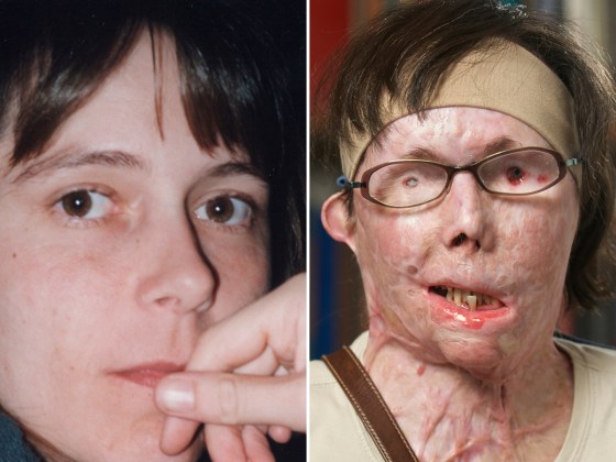 Carmen Blandin Tarleton before the attack and in July 2011, prior to face transplant surgery.