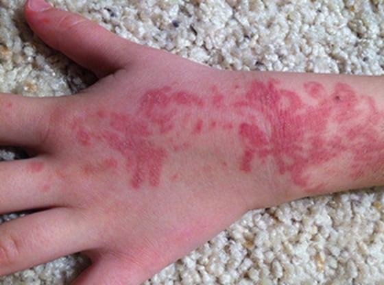 A 5-year-old developed severe reddening where the tattoo was placed.