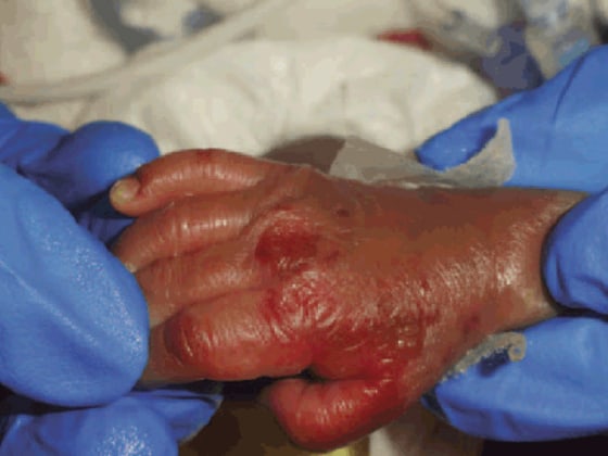 This premature baby girl was one of three infants who developed severe skin lesions and other problems at a Washington, D.C., hospital as a result of severe zinc deficiency stemming from a nationwide shortage of injectable zinc. Emergency supplies were rushed to those babies, who are now doing well, but the shortage continues, doctors say.