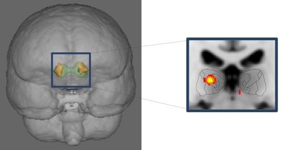 The migraine brain is more excitable than the healthy brain. This example illustrates abnormal activation (in red, on the right) in the thalamus (gre...