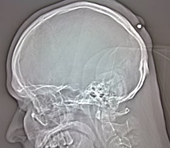 Image: X-ray of the skull of a man with a bullet in the back of his head