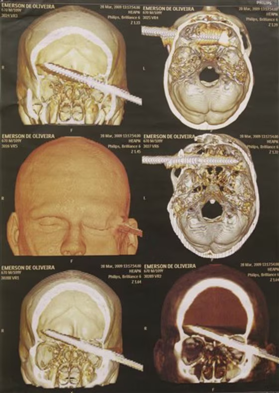 APTOPIX Brazil Spear in Head