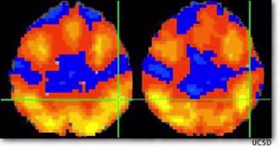 Brain imaging found differences between activity patterns for women who were not alcoholics, at left, and alcohol-dependent women, at right. Could imagery be used to identify alcoholics?