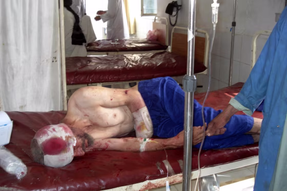 A wounded Afghan man is hospitalized after a bomb explosion about 150 yards away from a U.N office in Khost, south of Kabul, Afghanistan, on Sunday.