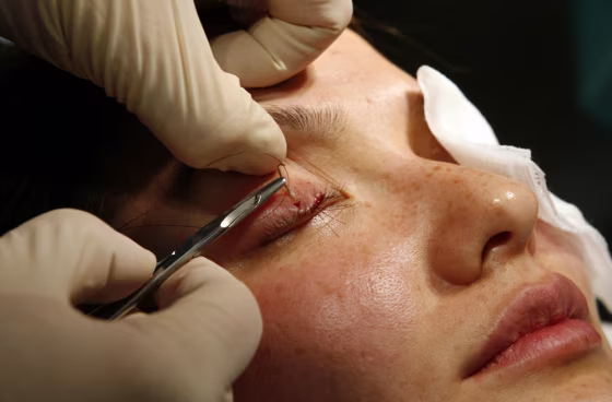 Doctor sews eyelash transplants into woman's eyelids to make her lashes longer during surgery in Los Angeles