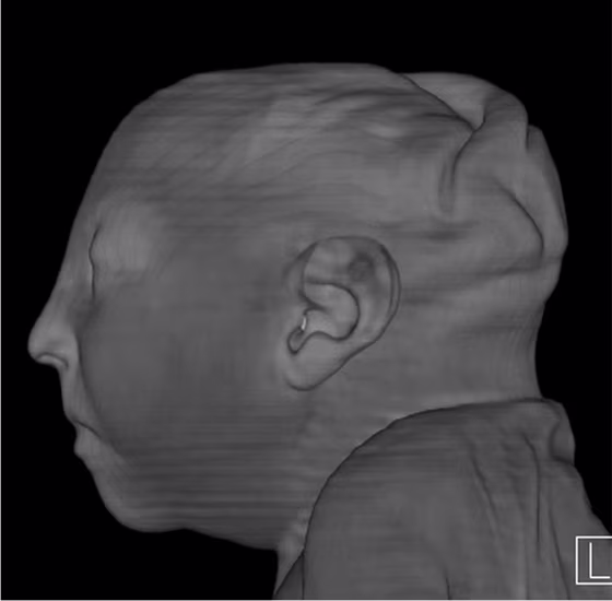 CT image 1 week after delivery at 38 weeks of gestational age in the case of a 24-year-old woman pregnant with twins, with characteristic rash at 9 weeks of pregnancy and confirmed Zika virus infection.